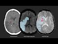 Anticoagulation After Stroke