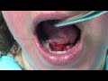 Salivary Duct Stone - Sialolithiasis - How to Treat?