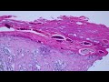 Melanocytic Dermpath Basics: Melanoma