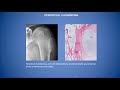 Cartilage forming tumors - Dr. Garcia (Hospital for Special Surgery) #BSTPATH