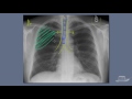 Chest X-Ray Interpretation Explained Clearly - How to read a CXR