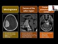 Imaging of brain tumors (part 1): metastases, glioblastoma and beyond...