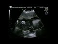 28 week scan with Window to the Womb