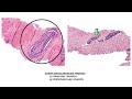 PURSUE 1-V-    EPITHELIAL TUMOURS OF THE PROSTATE:      ACINAR ADENOCARCINOMA