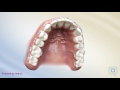 Orthodontic Appliance
