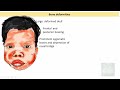 Hemolytic Anemias- Part 6: Beta Thalassemia- Pathogenesis, types, Diagnosis & Treatment