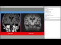 Normal Pressure Hydrocephalus: What Your Doctors are Thinking Before and After the Shunt is Placed