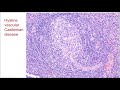 Approach to the lymph node - Dr. Crane (Cleveland Clinic) #HEMEPATH