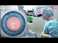 Contoura vision vs Femto Lasik - All questions answered: Dr. Shalini Sharma