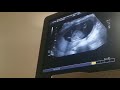 17 weeks ultrasound