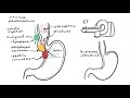 Achalasia (esophageal) - signs and symptoms, pathophysiology, investigations and treatment