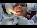 Treatment behel gigi setelah 2 bulan pasang behel ! Begini prosesnya