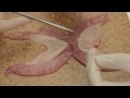 Side to side bowel anastomosis (simulated)