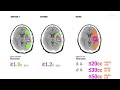 CT Perfusion In Acute Ischemic Stroke