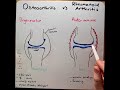 Osteoarthritis vs Rheumatoid arthritis in 2 mins!