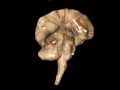 Brain Implant Surgical Procedure Animation