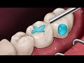 [ASMR] My teeth hurt so much! cavities treatment animation