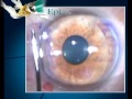 Epi-LASIK - Epi K Animation - MORIA - EN