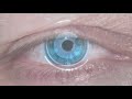 PRK (LASEK) Laser Eye Surgery: Animation high-quality patient education