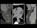 What is the difference between Coronary Calcium Scoring and CT Coronary Angiogram (2023)