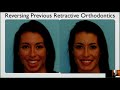 Can Orthodontic Retraction Be Reversed?