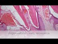 Angiokeratoma of Mibelli - Pathology mini tutorial