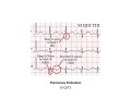 Electrocardiograms (ECG) Made Easy!