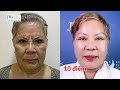 GIẬT MÌNH bà nội Việt kiều U80 giấu con cháu về Bác sĩ Tú Dung CĂNG DA MẶT cải lão TRẺ ĐẸP 30 TUỔI