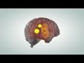 Animated video illustrating the pathophysiology of migraine