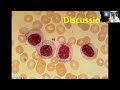 LGL Leukemia Case Discussion with Dr. Thomas Loughran, MD and Dr. Taha Bat, MD | BMFcases.com