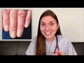 Doctor Explains what your NAILS say about your HEALTH: Top 10 Nail Problems