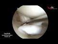 Watch a Knee Surgeon Treat a Meniscal Tear