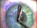 Epi-LASIK - Dr. R. Milne - Epi-K - MORIA - EN