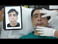 Best Surgery Results For Asymmetrical Face Correction - Splint Removal