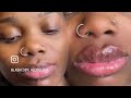 Exposing The Dangerous Lip Filler Techs Of TikTok