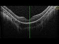 Mastering OCT Interpretation with Dr. Mark Friedberg