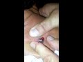 Infected Cyst Lanced Pimple Popping Blackhead Blood Squirts!! Gross!!! How A Redneck Does it!