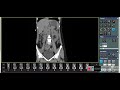 abdomen and pelvic CT scan without oral and IV contrast,coronal view