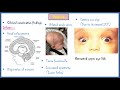 Hydrocephalus - Causes, Types, Signs and Symptoms, Pathophysiology, Diagnosis and Treatment