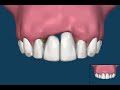 Which is better a dental bridge or implant?