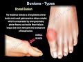 Bunions Types - Everything You Need To Know - Dr. Nabil Ebraheim