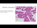 Pursue 7 Y  :Meningioma & Mesenchymal tumors of CNS