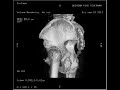 Fractura oculta cadera (Radiografia y TAC)