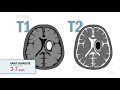 Diagnosis and Management of Cerebral Venous Thrombosis