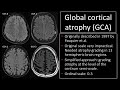 Imaging of dementia and brain ageing.