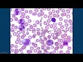 Hemepath & Hematology Board Review: Peripheral Blood Smears with Dr. Jeanette Ramos