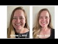 6 Month Post Op with Progress Pics! Gastric Bypass/RNY/Bariatric Surgery Update