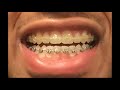 BEFORE & AFTER BRACES! | Very Bad Crossbite Correction!!