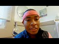 Bunion Surgery Recovery Vlog - Part 2 Seva Foot and Ankle Center