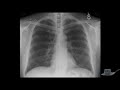 Chest X Ray Interpretation Explained Clearly - How to read a chest Xray